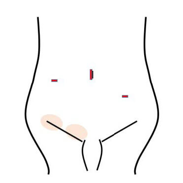 腹腔鏡下手術の手術創