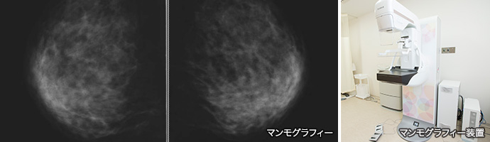 マンモグラフィー（乳房X線撮影）