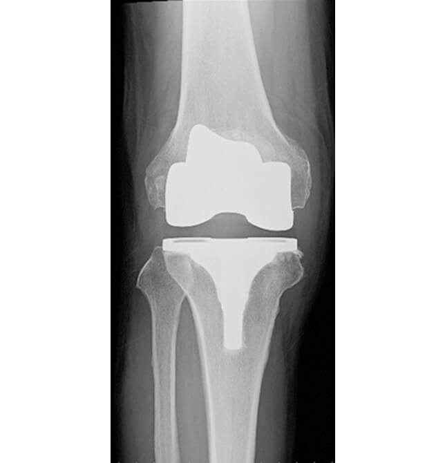 人工膝関節全置換術（TKA）手術後