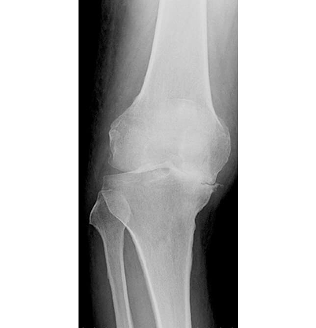 人工膝関節全置換術（TKA）手術前