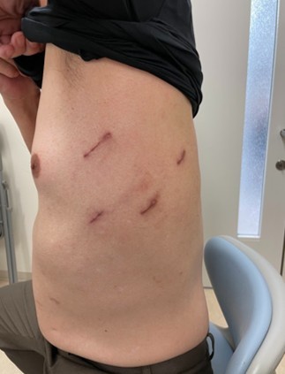 術後1年後の手術痕