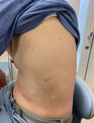 術後5年後の手術痕